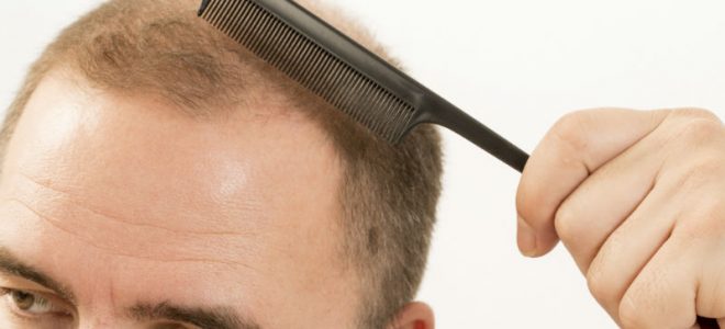 Hair Loss, Medical Conditions, and Treatment Options in Summerville, SC