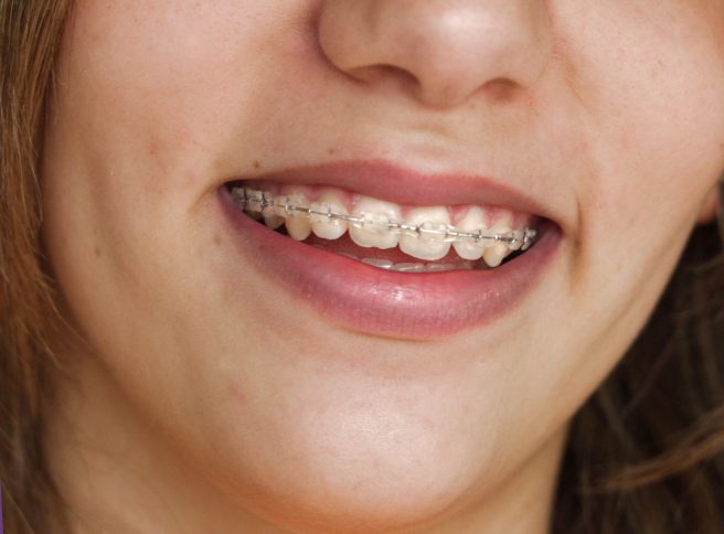 Benefits Of Visiting An Orthodontist In Medina OH, Find Services