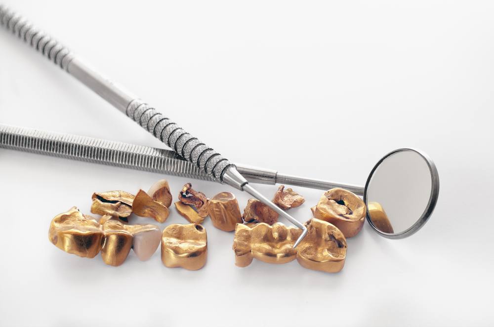 How to Identify Trustworthy Dental Gold Buyers: What to Look For